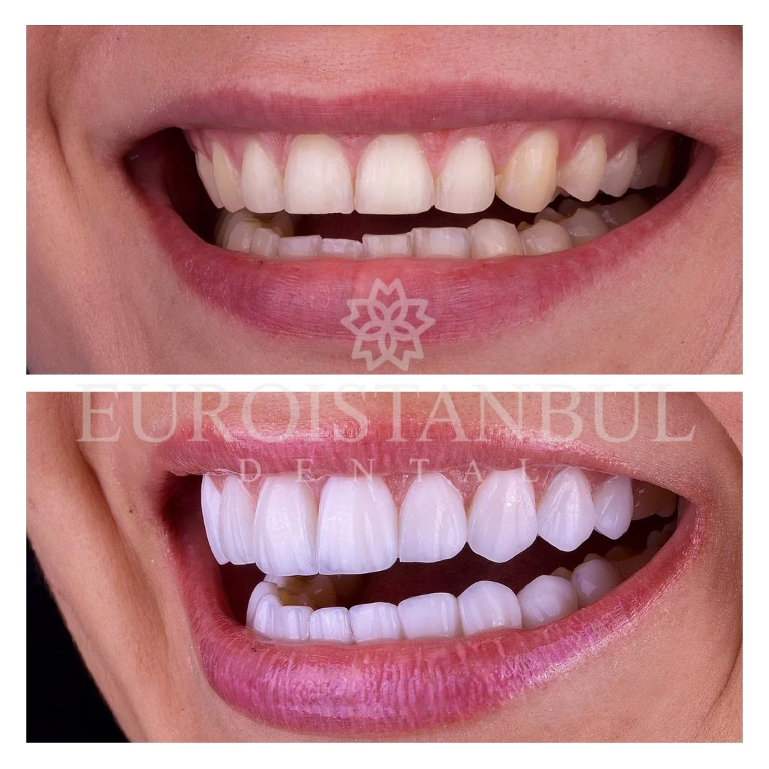 dental-veneer-turkey-price