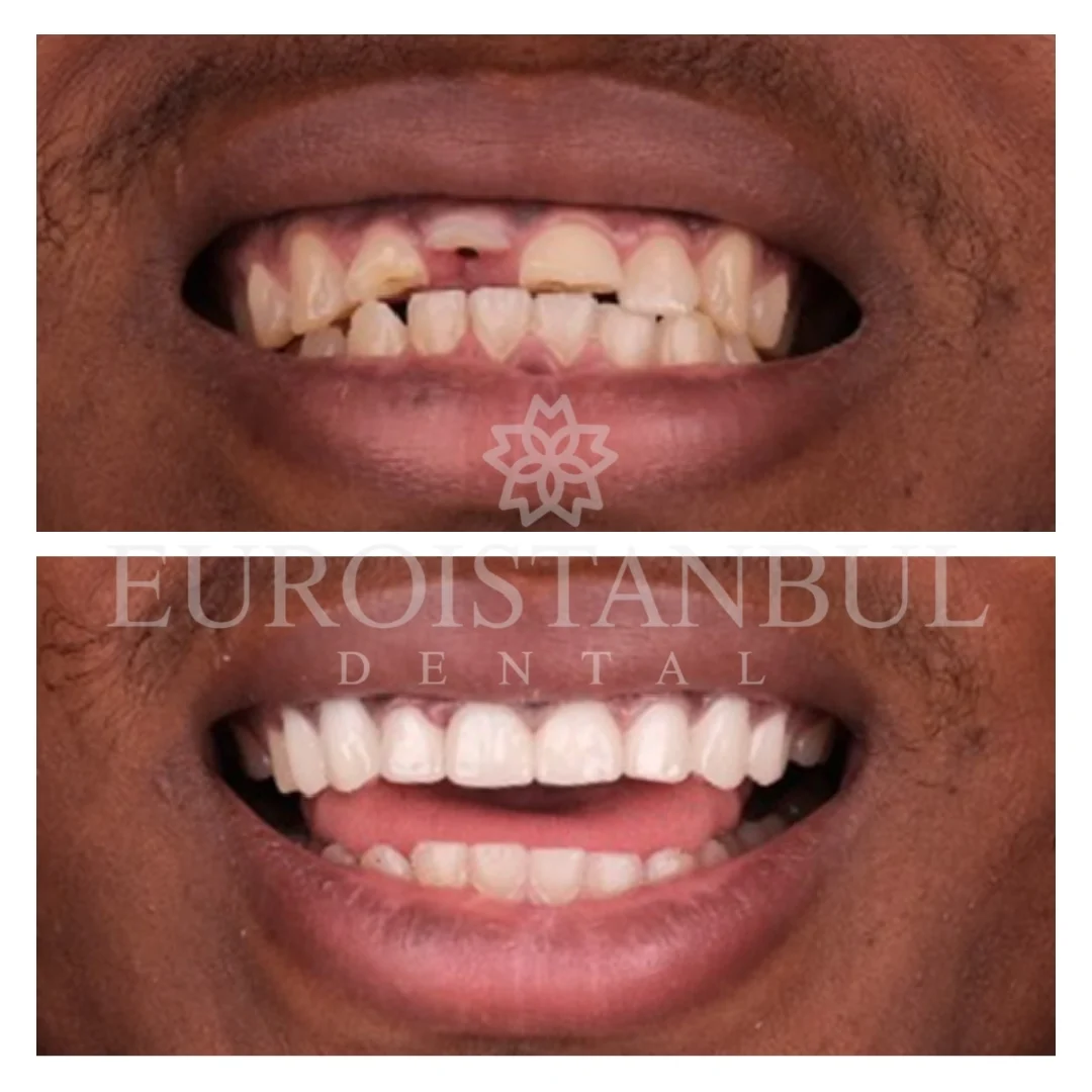 dental-veneer-turkey-prices