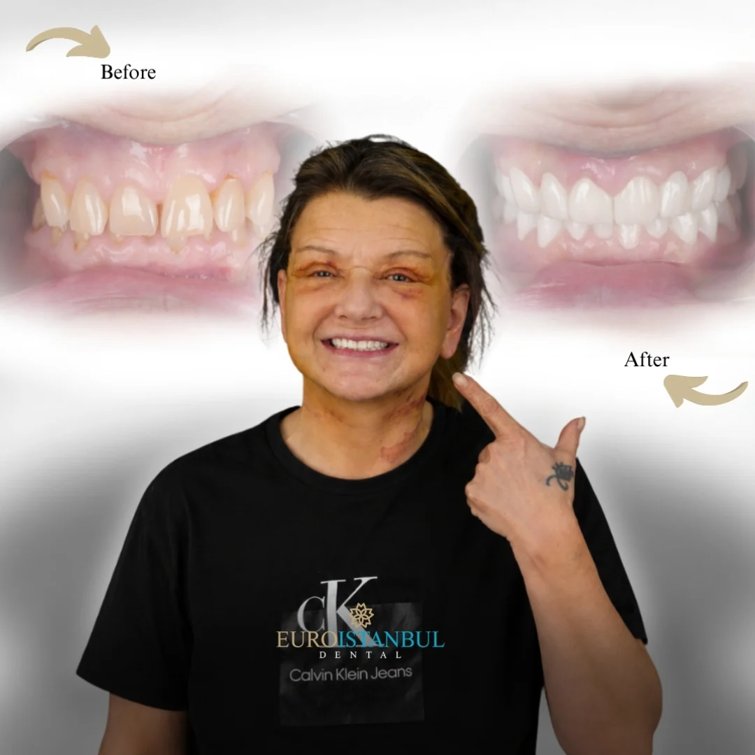 dental-veneer-turkey-prices