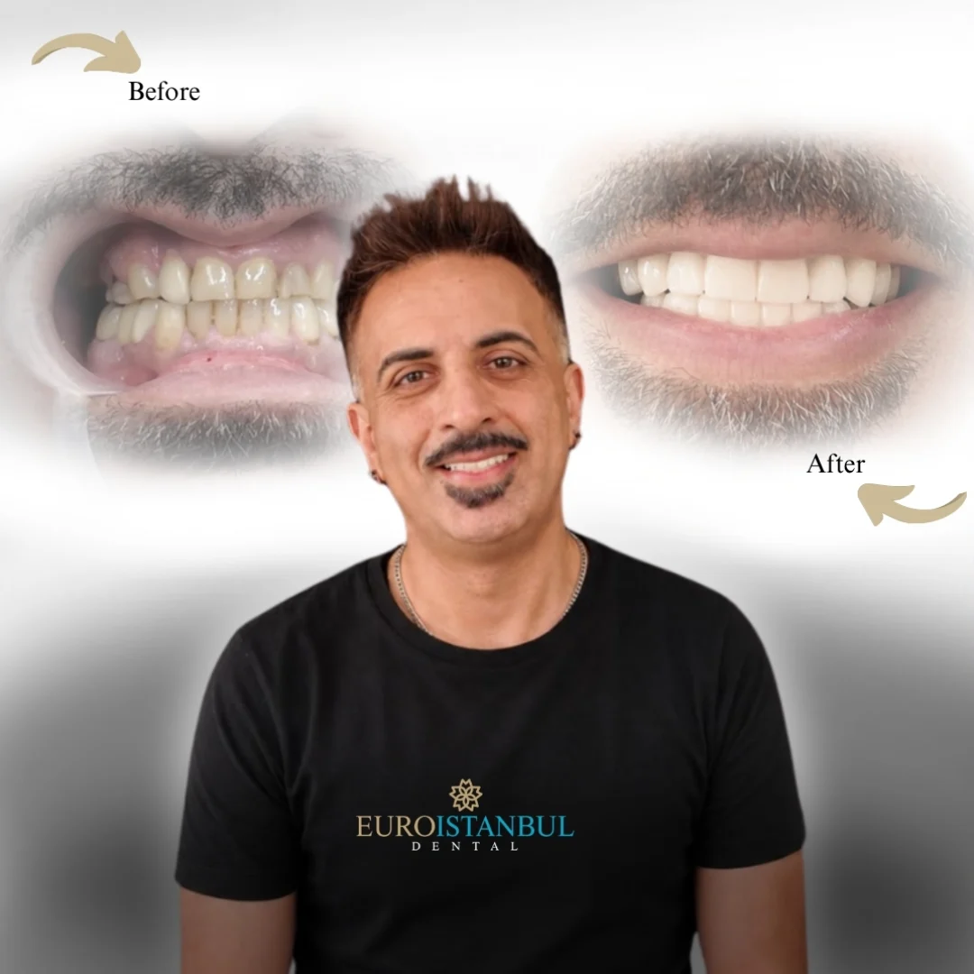dental-veneer-turkey