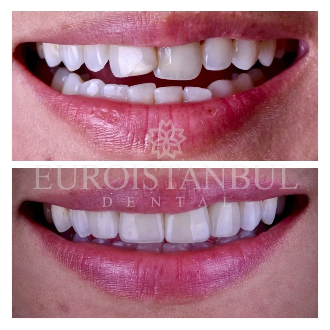 dental-zirconia-crown-istanbul-11
