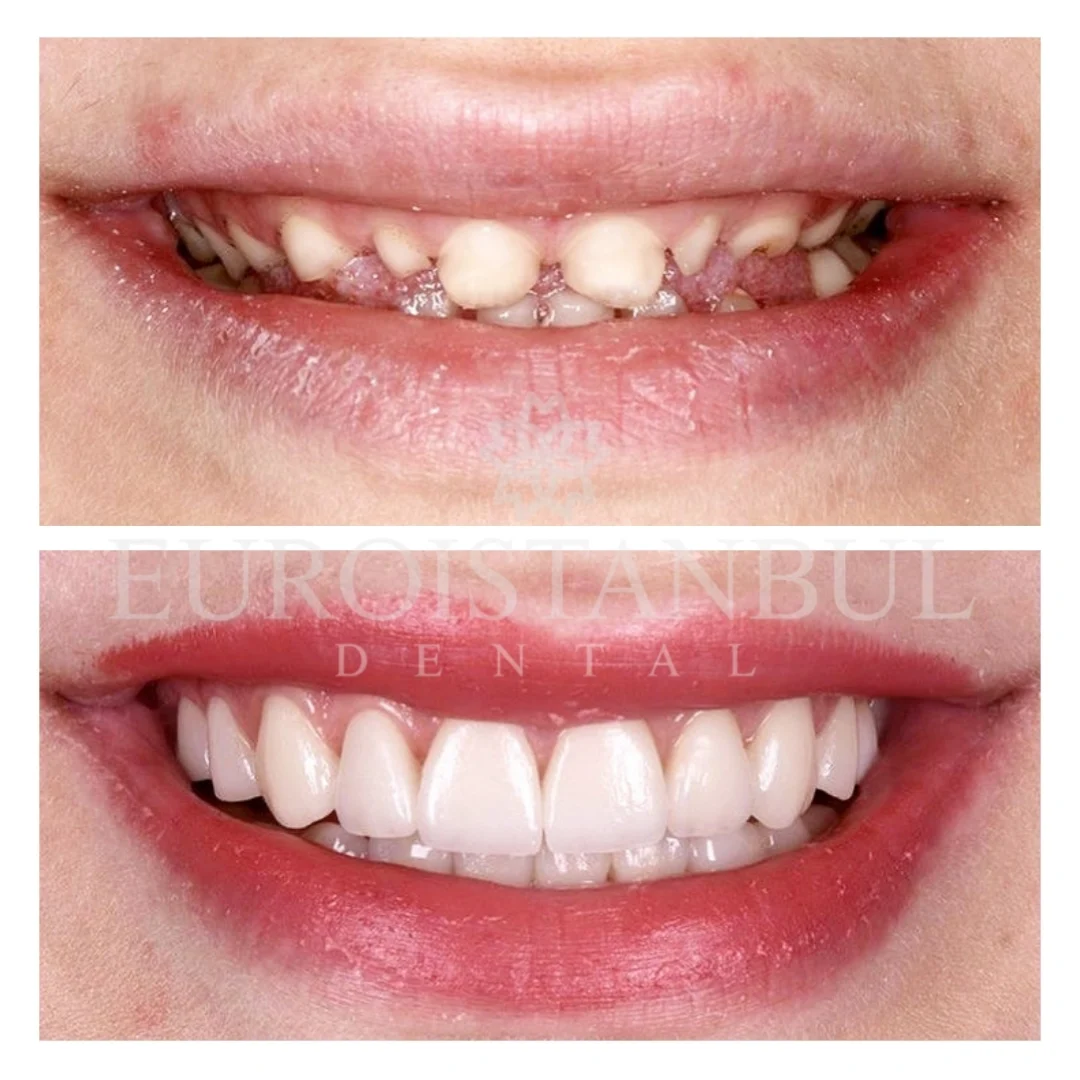 dental-zirconia-crown-istanbul-12