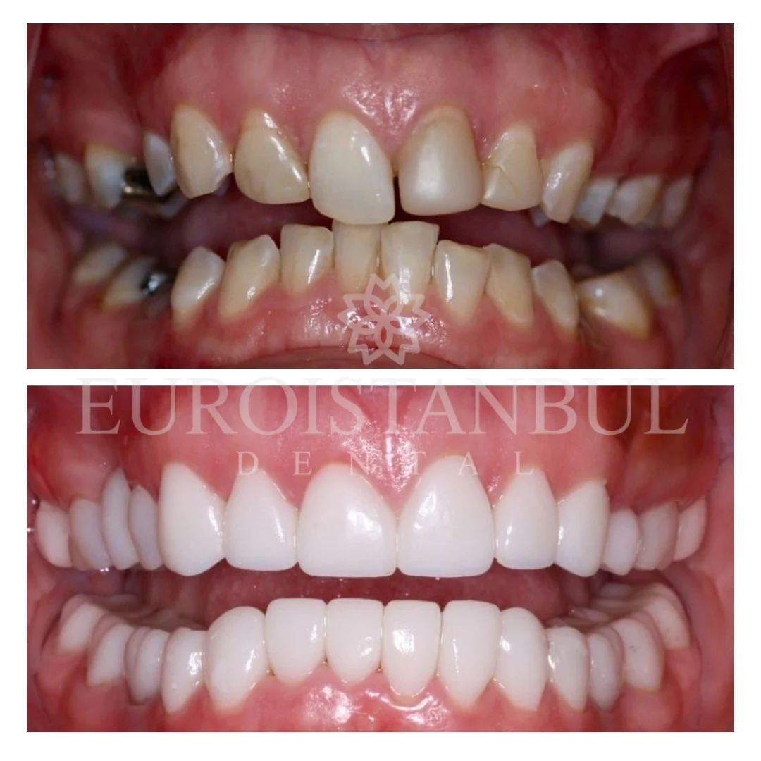 dental-zirconia-crown-istanbul-13