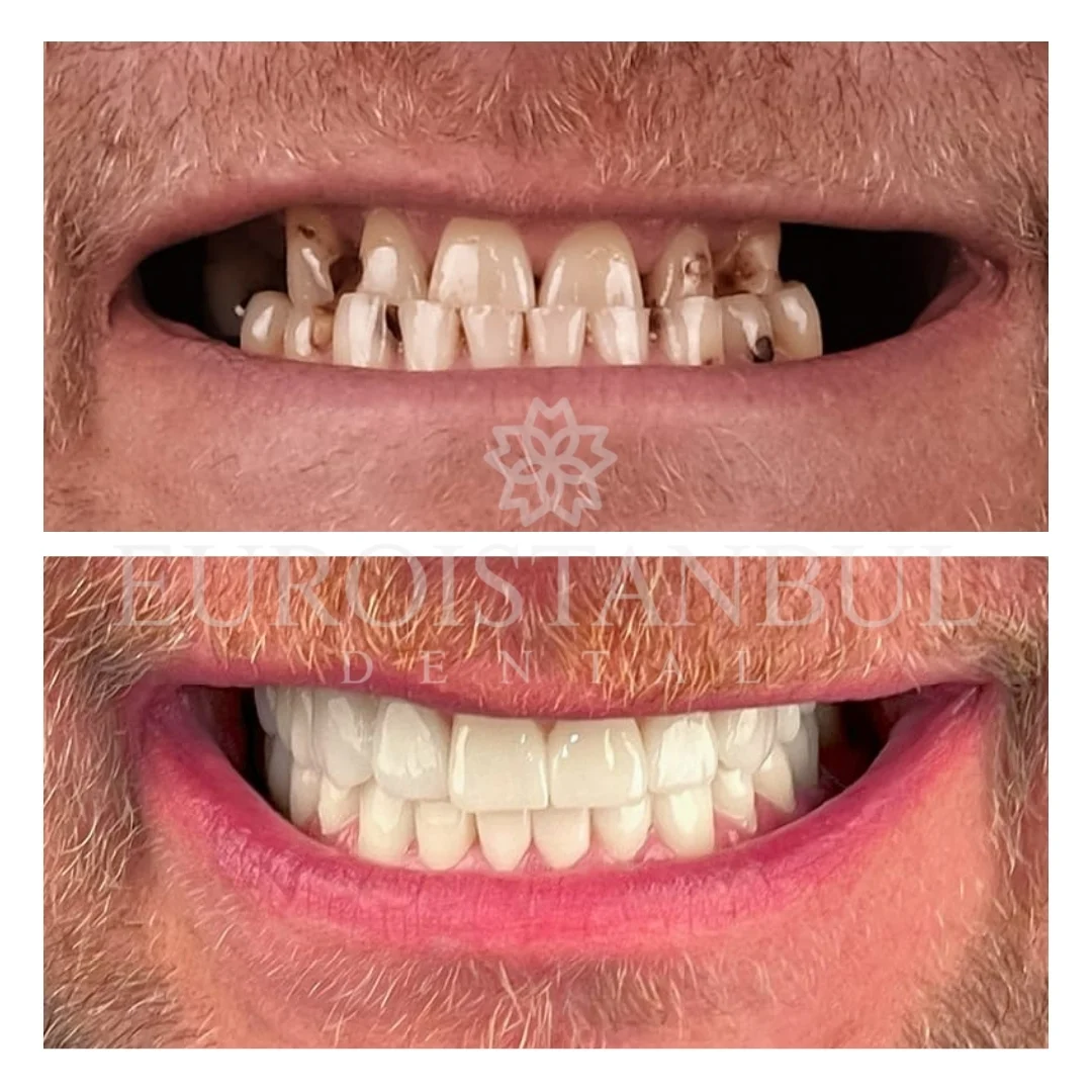 dental-zirconia-crown-istanbul-cost-2