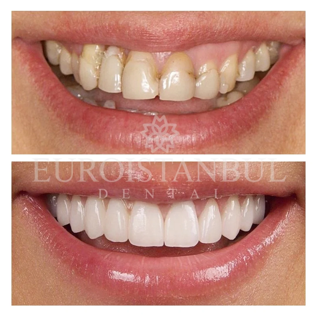 dental-zirconia-crown-istanbul-cost-3