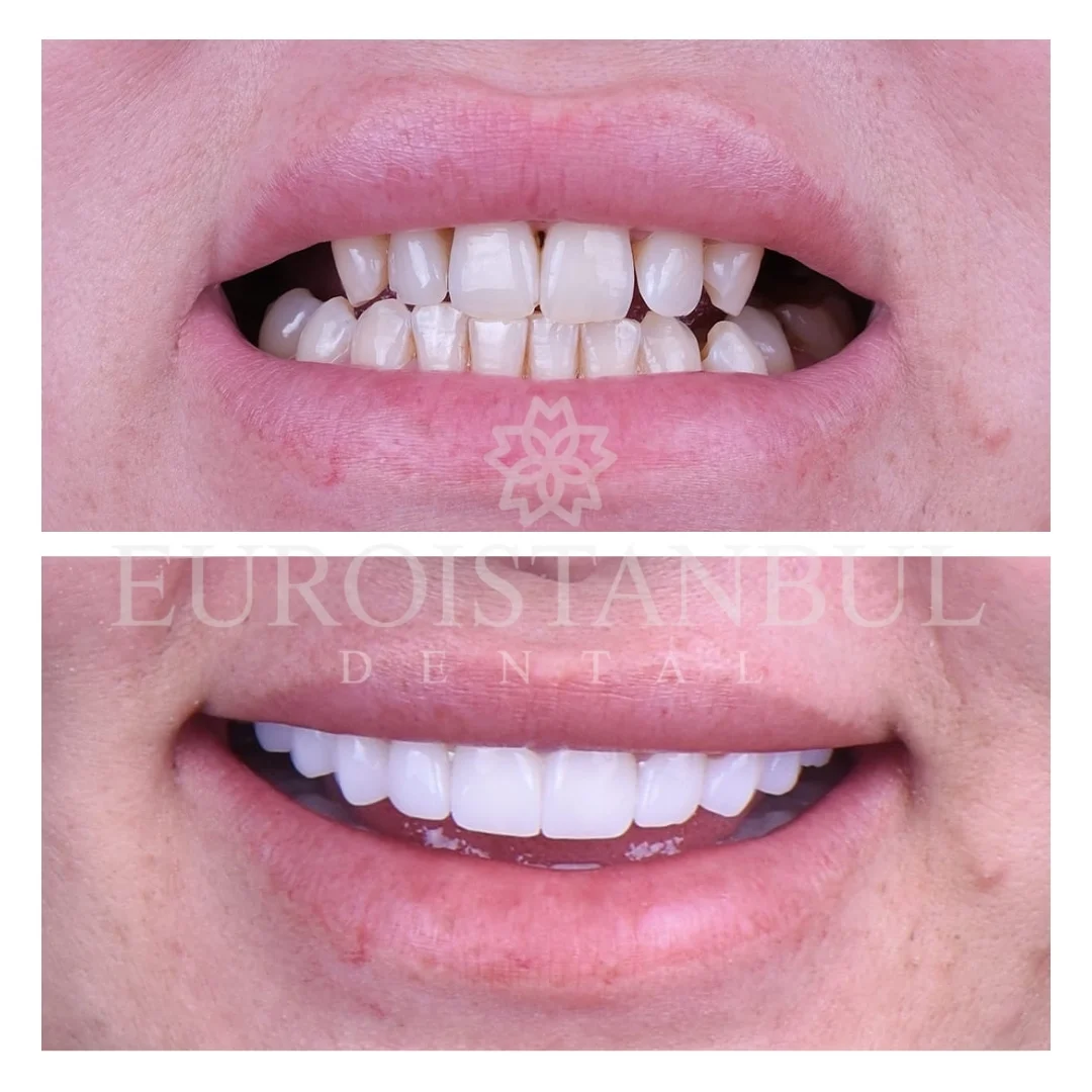 dental-zirconia-crown-istanbul-cost