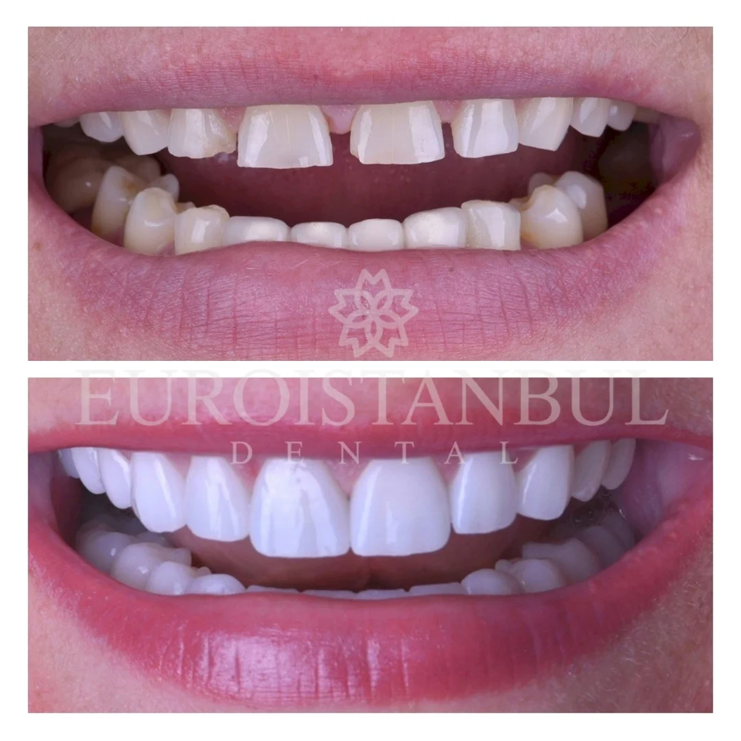 dental-zirconia-crown-istanbul-price-2