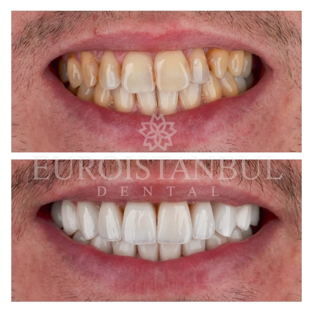 dental-zirconia-crown-istanbul-price