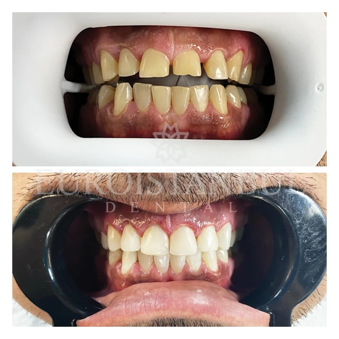 dental-zirconia-crown-turkey-11