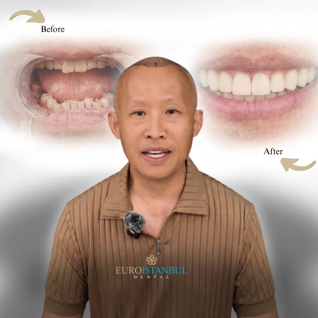 dental-zirconia-crown-turkey-cost