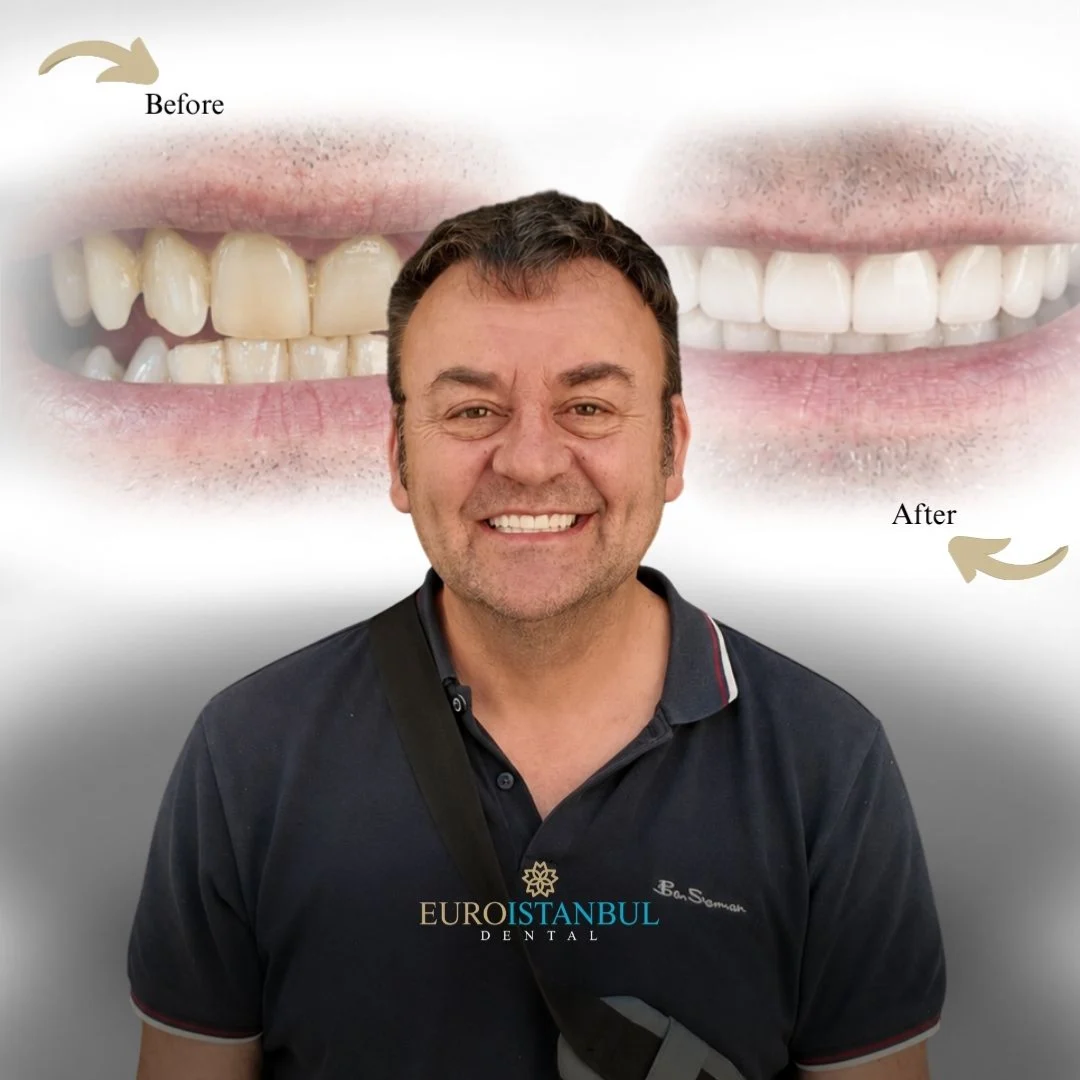 dental-zirconia-crown-turkey-price