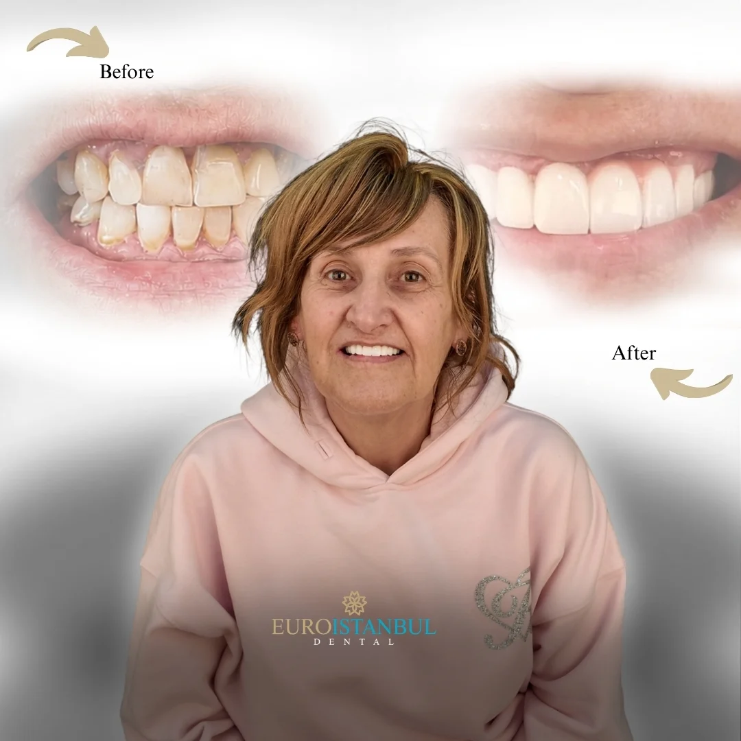 dental-zirconia-crown-turkey