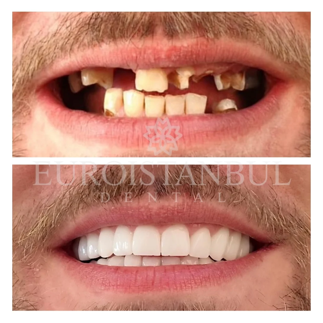 hollywood-smile-istanbul