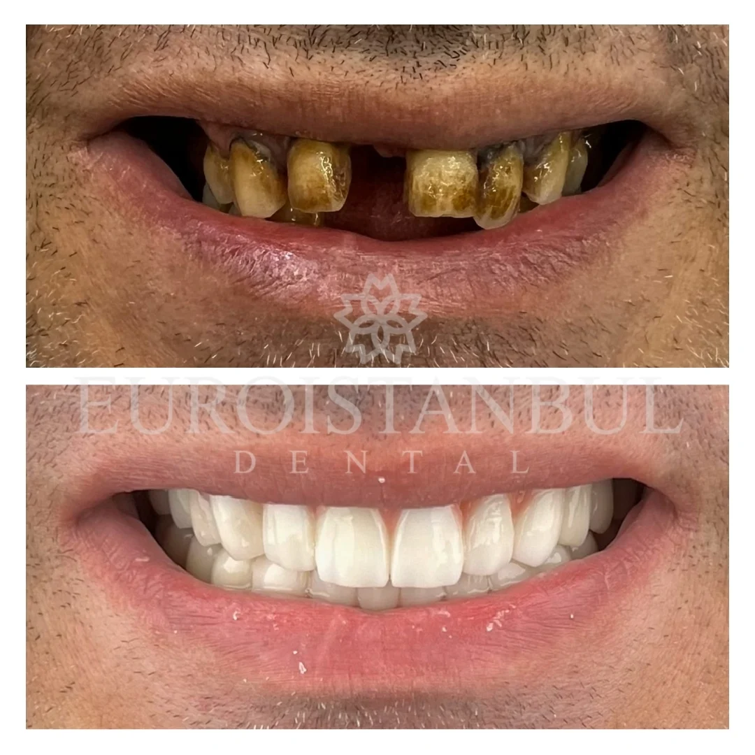 hollywood-smile-turkey