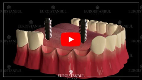 implant video